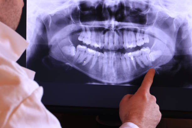 Best Emergency Dental Care for Broken or Chipped Teeth in Lake Riverside, CA