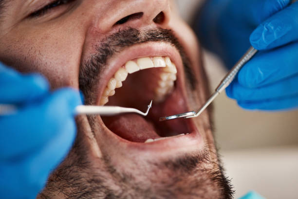 Best Emergency Treatment for Dental Infections or Abscesses in Lake Riverside, CA